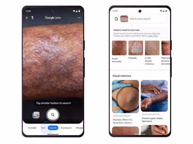 Interfaz de Google Lens para el reconocimiento de reacciones en la piel