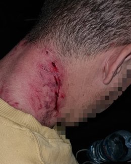 Una mordedura del perro en el cuello del hombre.